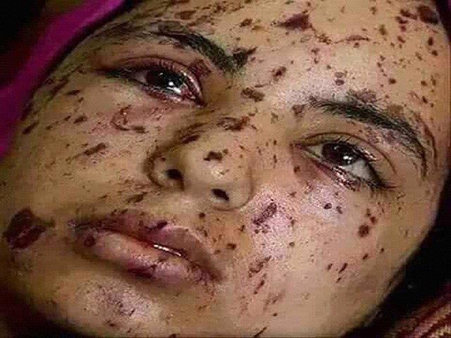 NGOs step in to provide help to pellet victims